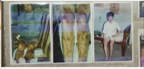 以身试药的中医传奇：刘中胜与他的烧伤康复“神膏”