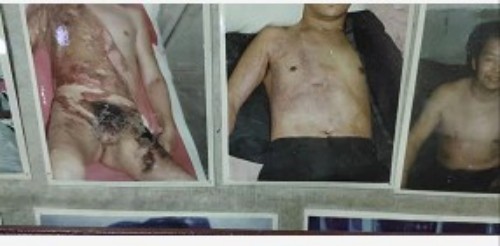 以身试药的中医传奇：刘中胜与他的烧伤康复“神膏”