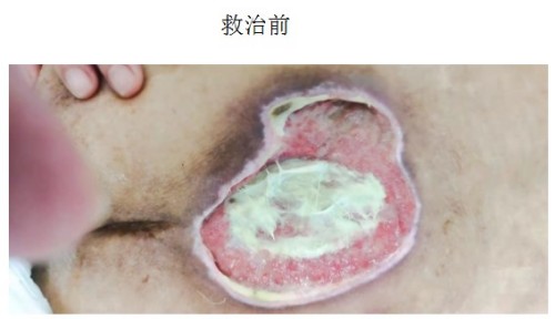 以身试药的中医传奇：刘中胜与他的烧伤康复“神膏”