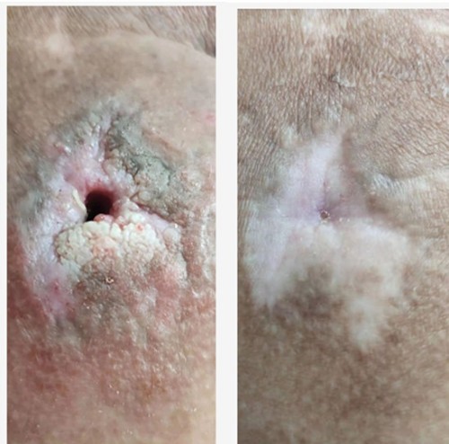 以身试药的中医传奇：刘中胜与他的烧伤康复“神膏”