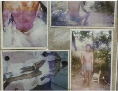 以身试药的中医传奇：刘中胜与他的烧伤康复“神膏”