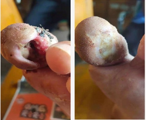 以身试药的中医传奇：刘中胜与他的烧伤康复“神膏”