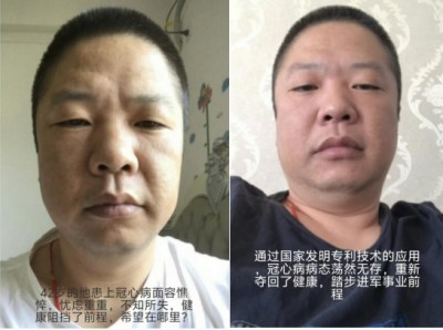 冠心病！世界医学研究难以治愈。中国发明！痊愈冠心病突破难关！