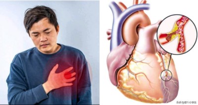 冠心病！世界医学研究难以治愈。中国发明！痊愈冠心病突破难关！