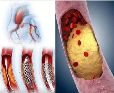 冠心病！世界医学研究难以治愈。中国发明！痊愈冠心病突破难关！