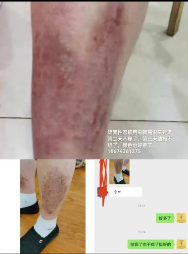 易新亮雷氧细胞针灸:让三高糖尿病断药，风湿断根，肿瘤不用放化疗！